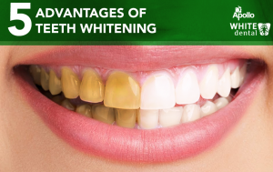 5 Advantages Of Teeth Whitening
